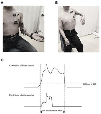 The Muscle Activation Differences in Post-Stroke Upper Limb Flexion Synergy Based on Spinal Cord Segments: A Preliminary Proof-of-Concept Study